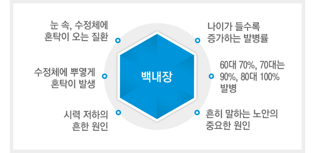 백내장이란