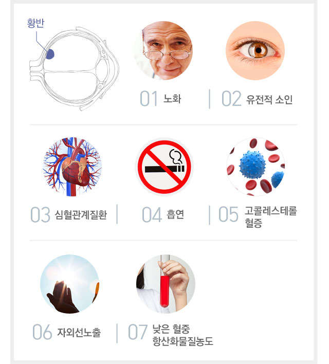 황반변성원인