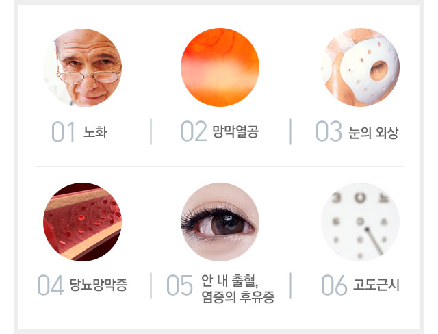 비문증원인