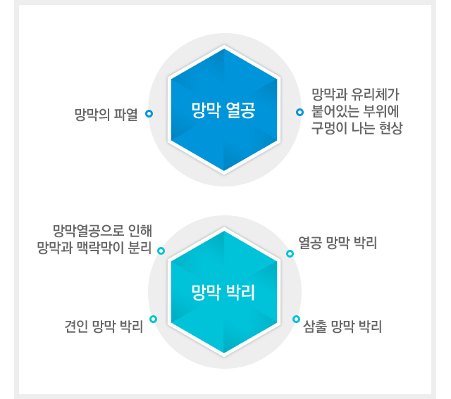 망막 열공 및 망막 박리이란