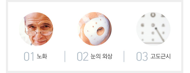 망막 열공 및 망막 박리원인
