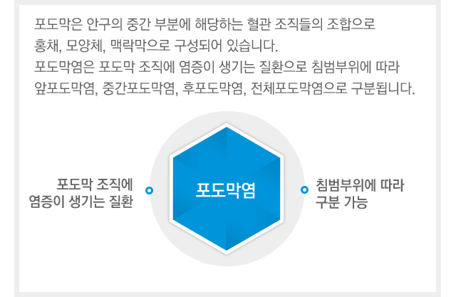 포도막염이란
