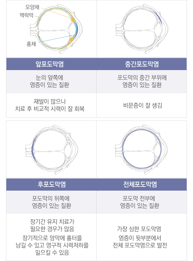 포도막염종류