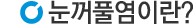 눈꺼풀염이란